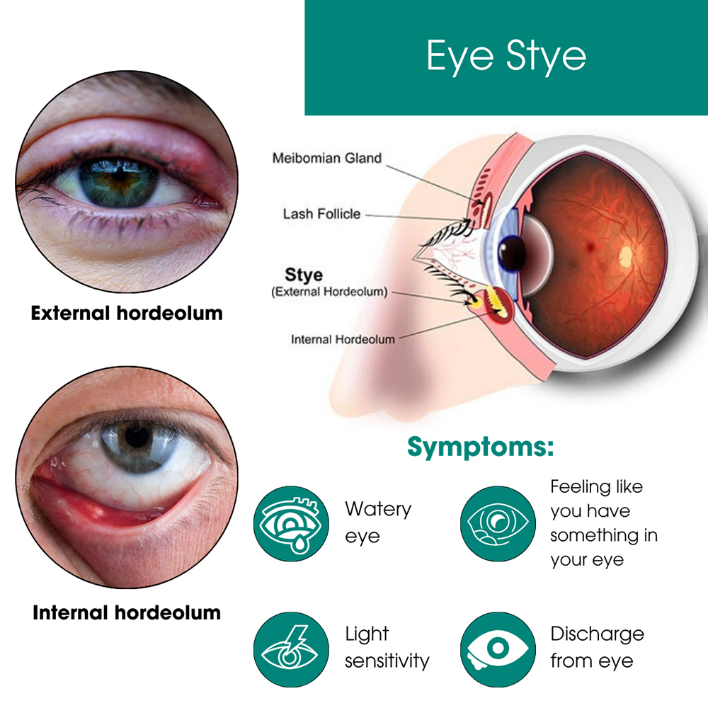 How do you get rid of a stye in 5 minutes