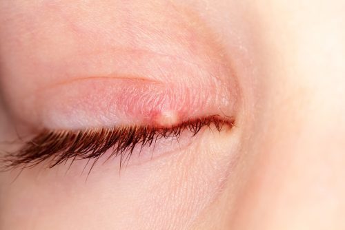 How do you get rid of a stye in 5 minutes