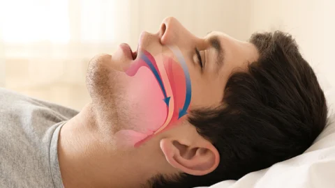 Obstructive Sleep Apnea
