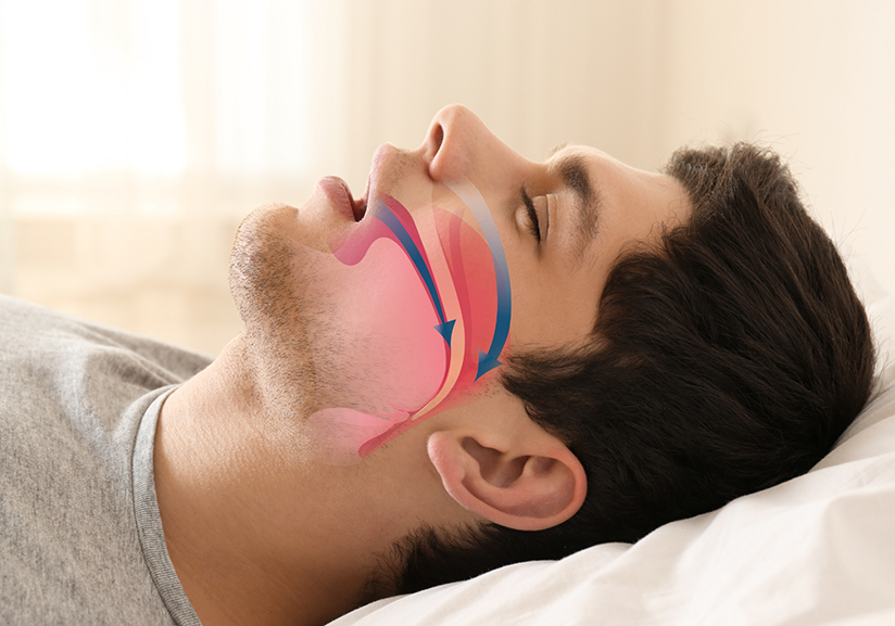 Obstructive Sleep Apnea